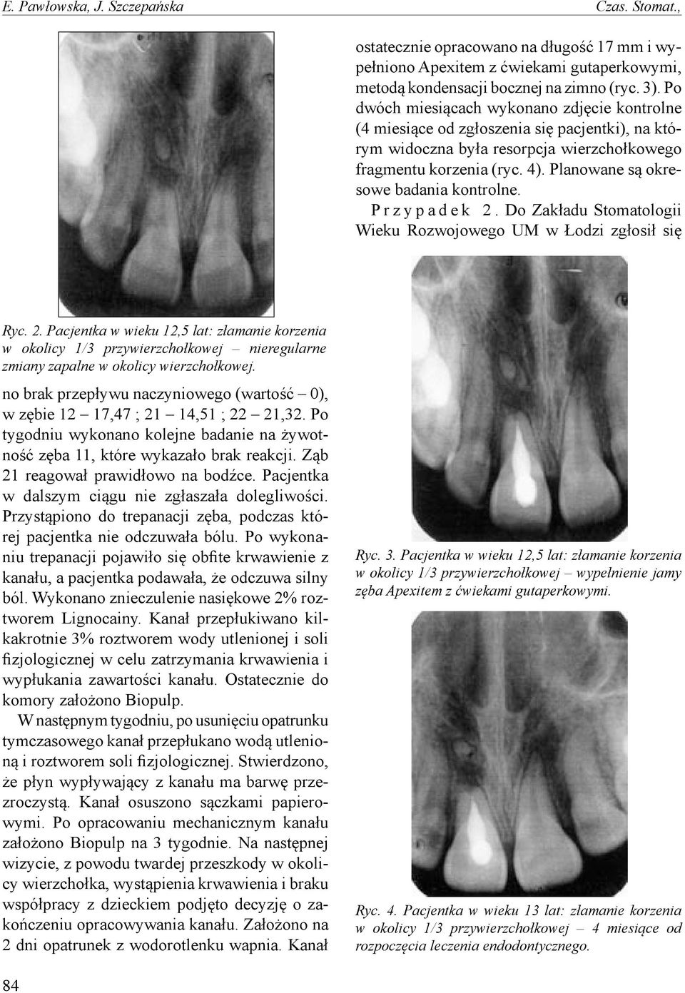 Planowane są okresowe badania kontrolne. P r z y p a d e k 2. Do Zakładu Stomatologii Wieku Rozwojowego UM w Łodzi zgłosił się Ryc. 2. Pacjentka w wieku 12,5 lat: złamanie korzenia w okolicy 1/3 przywierzchołkowej nieregularne zmiany zapalne w okolicy wierzchołkowej.