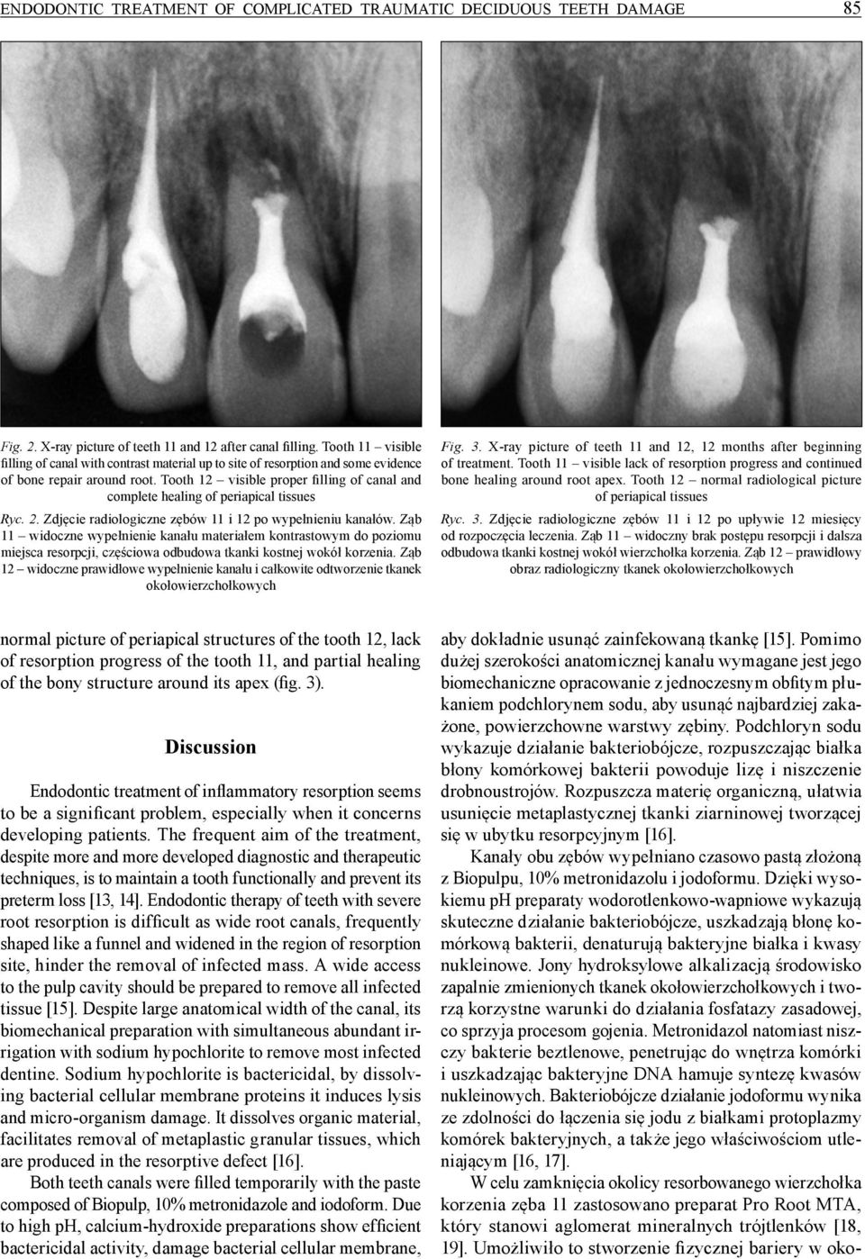 Tooth 12 visible proper filling of canal and complete healing of periapical tissues Ryc. 2. Zdjęcie radiologiczne zębów 11 i 12 po wypełnieniu kanałów.