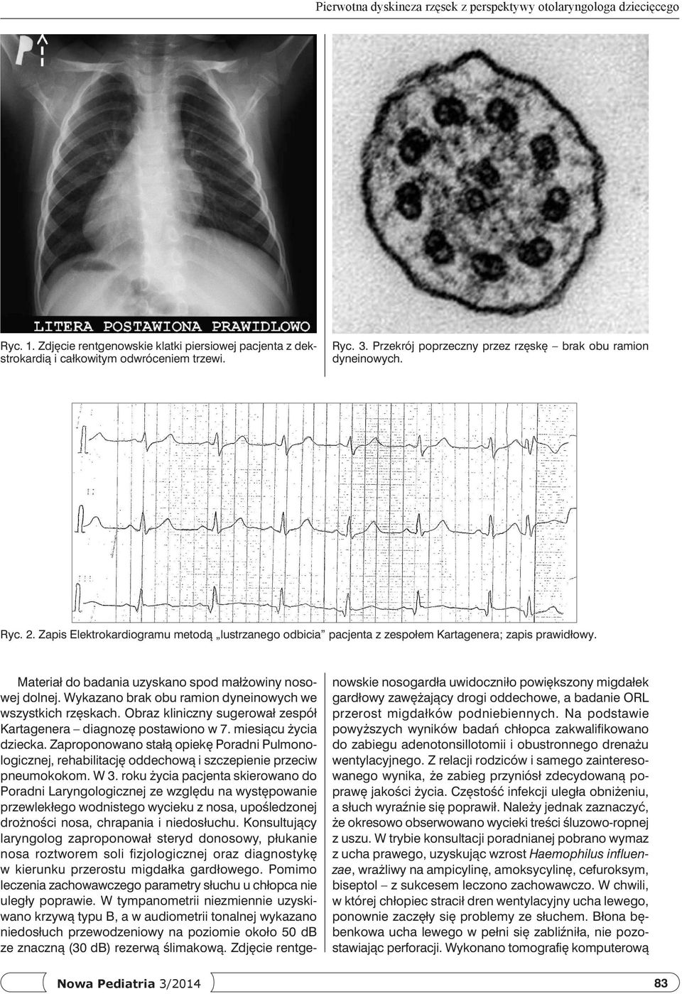 Materiał do badania uzyskano spod małżowiny nosowej dolnej. Wykazano brak obu ramion dyneinowych we wszystkich rzęskach. Obraz kliniczny sugerował zespół Kartagenera diagnozę postawiono w 7.