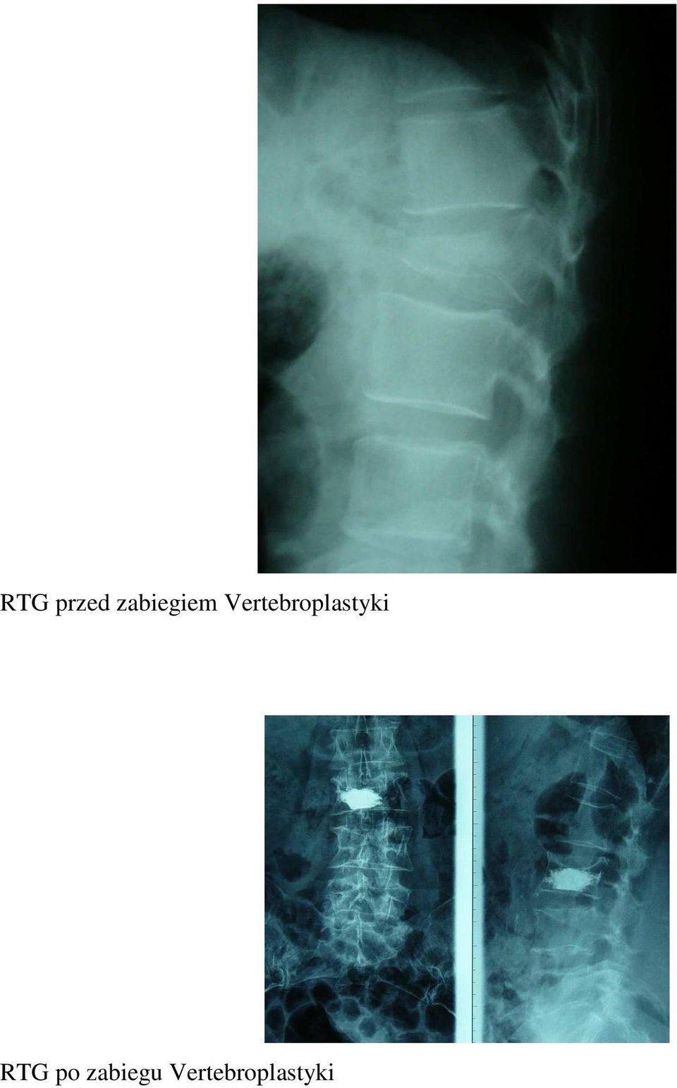 Vertebroplastyki