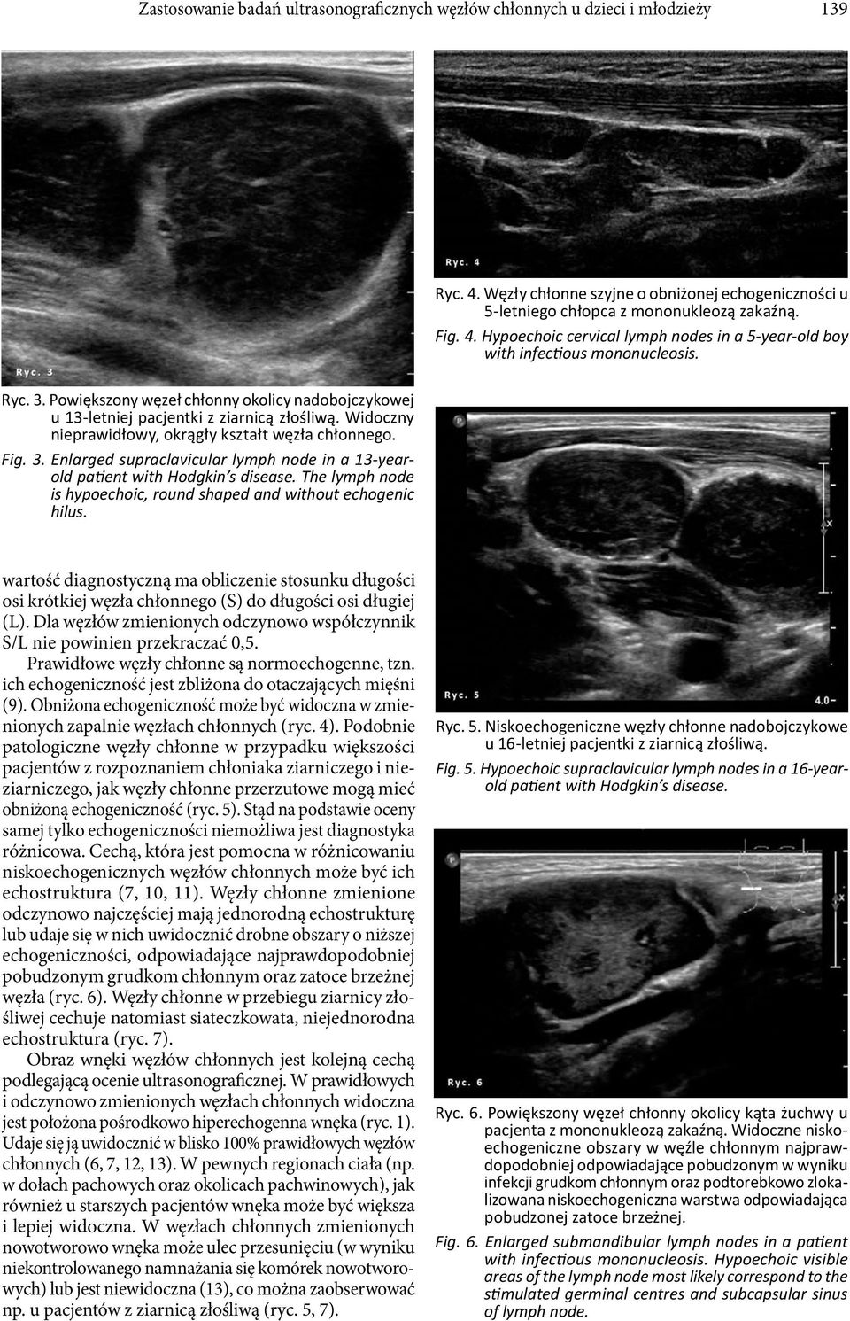 The lymph node is hypoechoic, round shaped and without echogenic hilus. wartość diagnostyczną ma obliczenie stosunku długości osi krótkiej węzła chłonnego (S) do długości osi długiej (L).