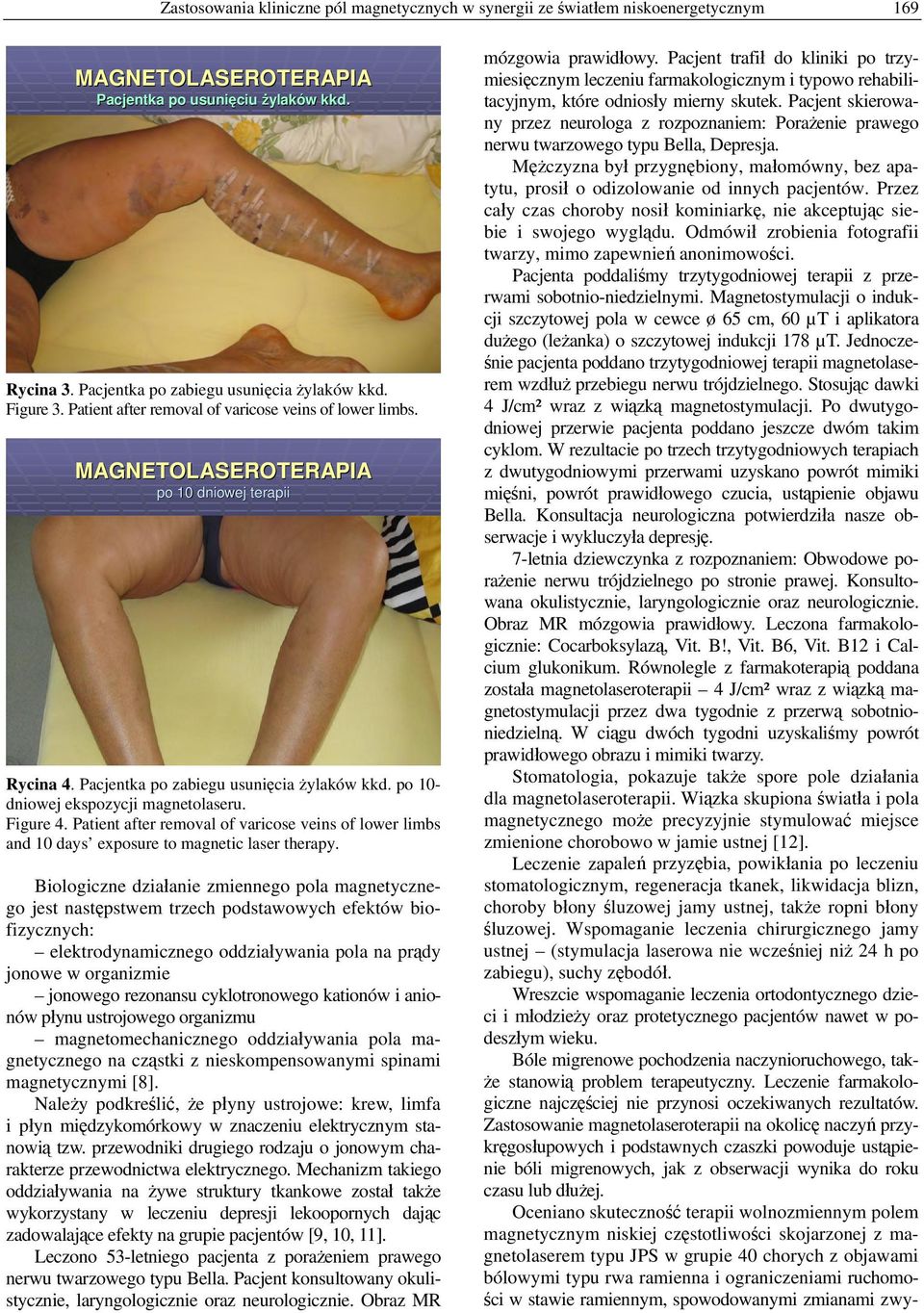 po 10- dniowej ekspozycji magnetolaseru. Figure 4. Patient after removal of varicose veins of lower limbs and 10 days exposure to magnetic laser therapy.