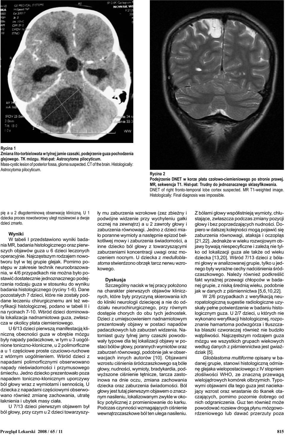 Hist-pat: Trudny do jednoznacznego sklasyfikowania. DNET of right fronto-temporal lobe cortex suspected. MR T1-weighted image. Histologically: Final diagnosis was impossible.