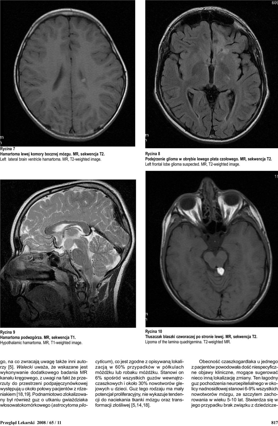 Rycina 10 T³uszczak blaszki czworaczej po stronie lewej. MR, sekwencja T2. Lipoma of the lamina quadrigemina. T2-weighted MR. go, na co zwracaj¹ uwagê tak e inni autorzy [5].