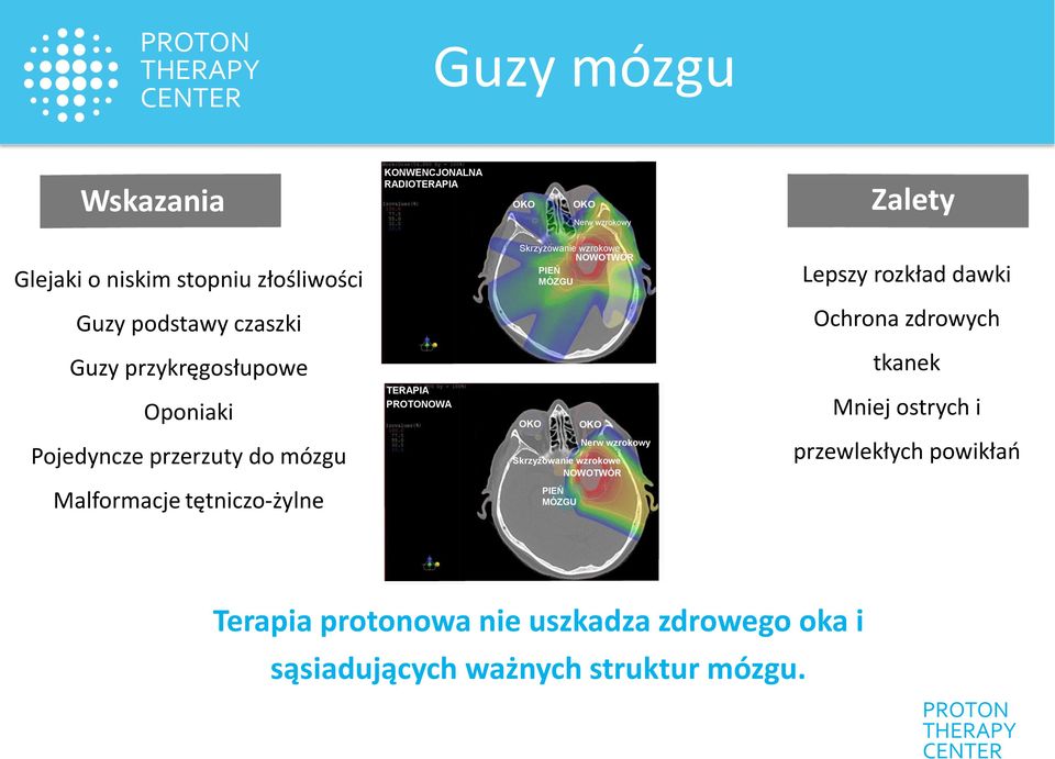 Oponiaki TERAPIA OWA OKO OKO Mniej ostrych i Pojedyncze przerzuty do mózgu Nerw wzrokowy Skrzyżowanie wzrokowe