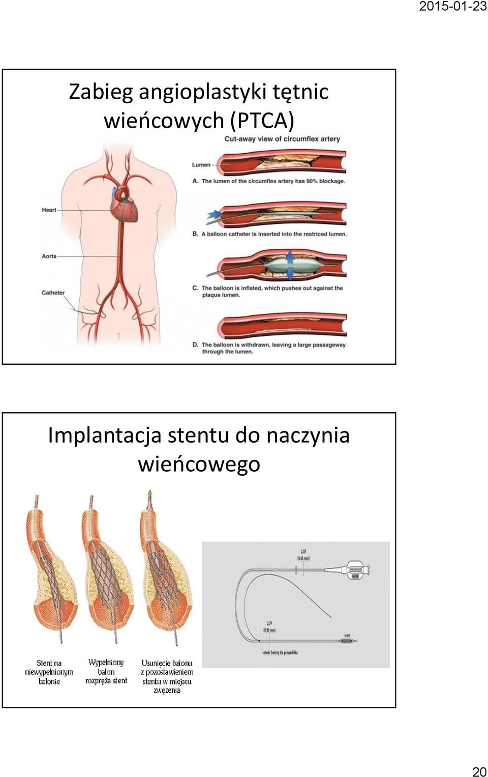 (PTCA) Implantacja