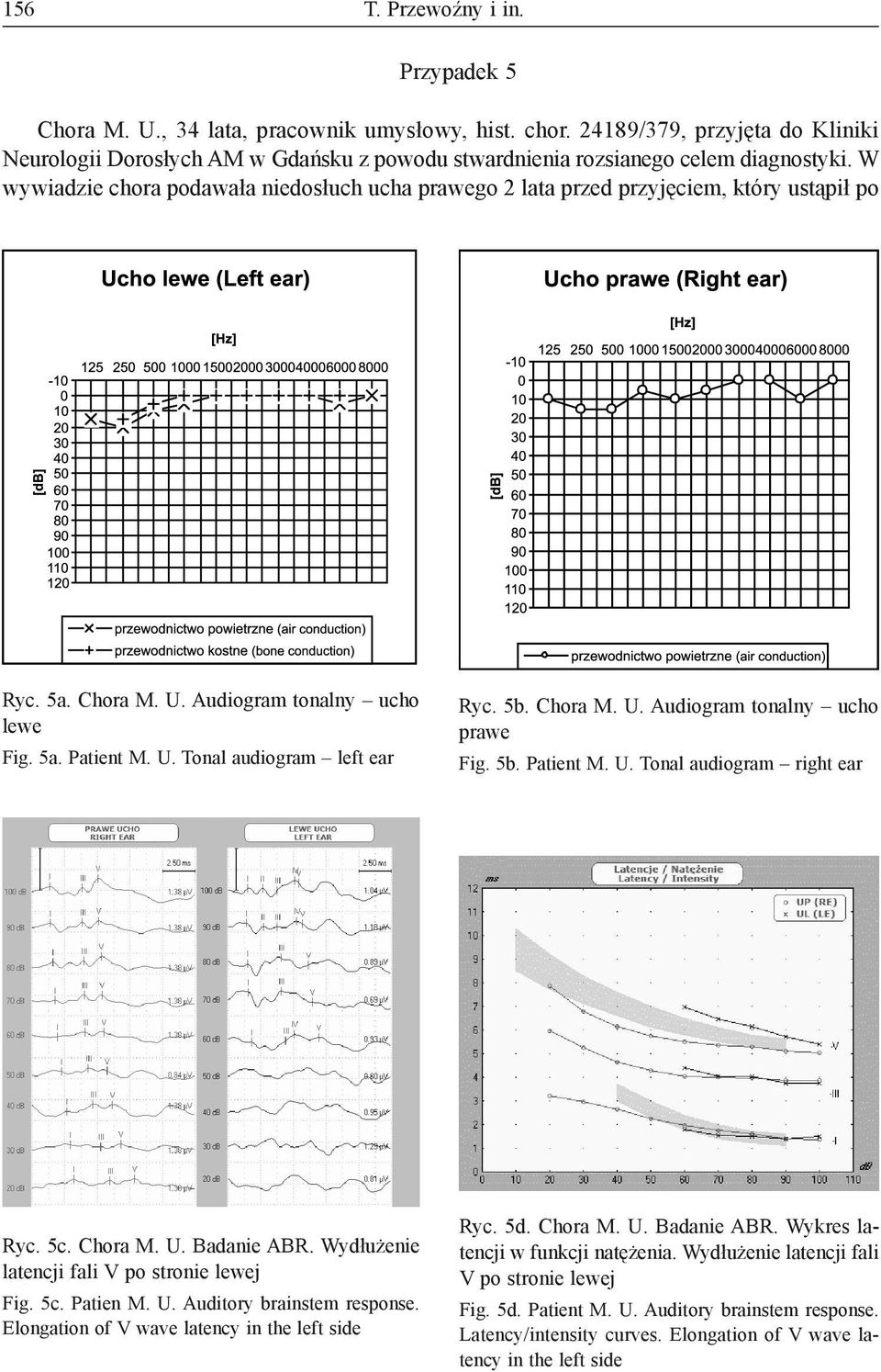 W wywiadzie chora podawała niedosłuch ucha prawego 2 lata przed przyjęciem, który ustąpił po Ryc. 5a. Chora M. U. Audiogram tonalny ucho lewe Fig. 5a. Patient M. U. Tonal audiogram left ear Ryc. 5b.