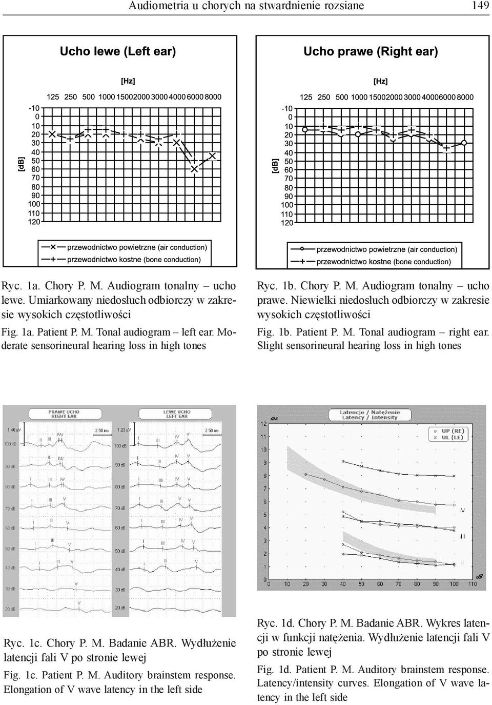 Slight sensorineural hearing loss in high tones Ryc. 1c. Chory P. M. Badanie ABR. Wydłużenie latencji fali V po stronie lewej Fig. 1c. Patient P. M. Auditory brainstem response.