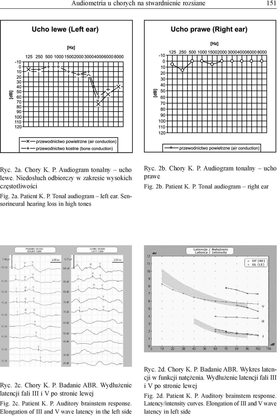 Wydłużenie latencji fali III i V po stronie lewej Fig. 2c. Patient K. P. Auditory brainstem response. Elongation of III and V wave latency in the left side Ryc. 2d. Chory K. P. Badanie ABR.