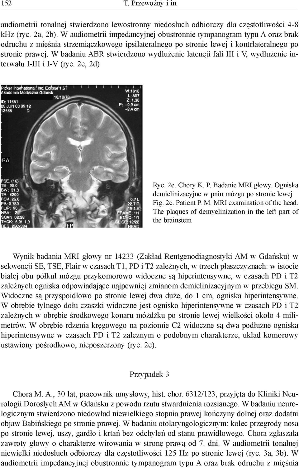 W badaniu ABR stwierdzono wydłużenie latencji fali III i V, wydłużenie interwału I-III i I-V (ryc. 2c, 2d) Ryc. 2e. Chory K. P. Badanie MRI głowy.