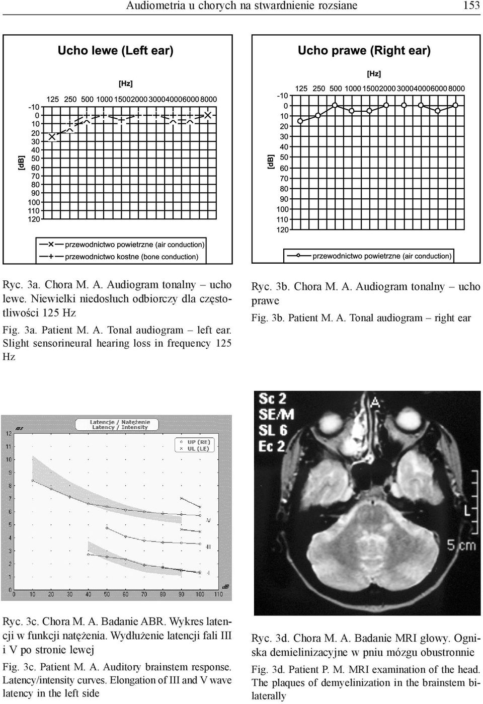 Wykres latencji w funkcji natężenia. Wydłużenie latencji fali III i V po stronie lewej Fig. 3c. Patient M. A. Auditory brainstem response. Latency/intensity curves.