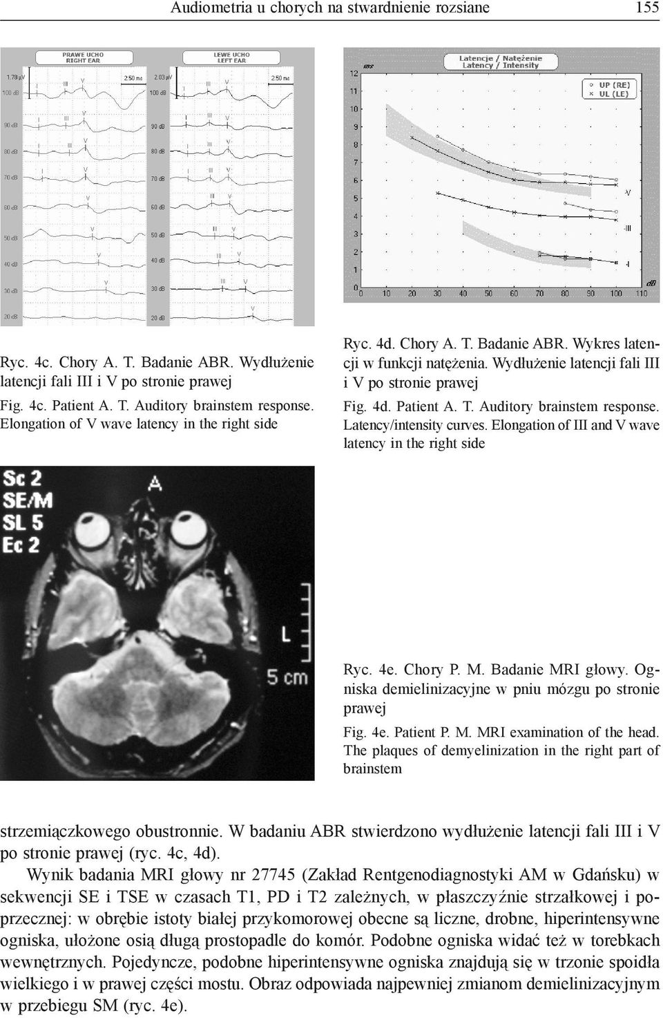 Latency/intensity curves. Elongation of III and V wave latency in the right side Ryc. 4e. Chory P. M. Badanie MRI głowy. Ogniska demielinizacyjne w pniu mózgu po stronie prawej Fig. 4e. Patient P. M. MRI examination of the head.