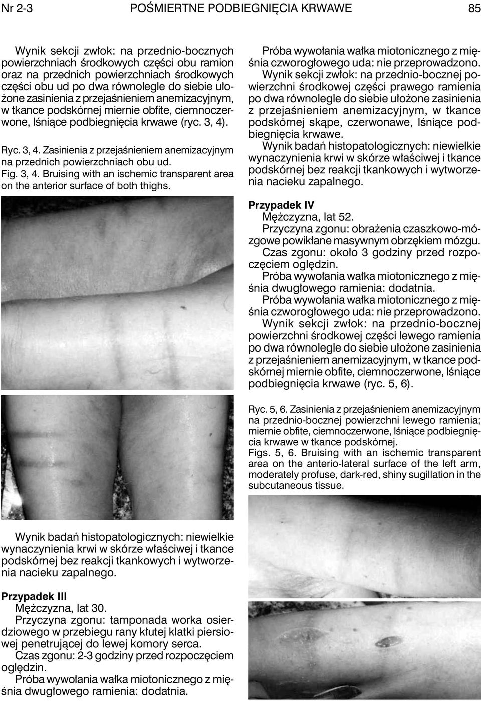 . Ryc. 3, 4. Zasinienia z przejaśnieniem anemizacyjnym na przednich powierzchniach obu ud. Fig. 3, 4. Bruising with an ischemic transparent area on the anterior surface of both thighs.