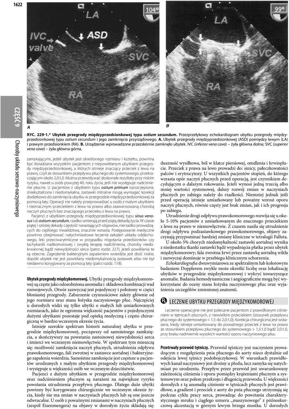 Ubytek przegrody międzyprzedsionkowej (ASD) pomiędzy lewym (LA) i prawym przedsionkiem (RA). B. Urządzenie wprowadzone przezskórnie zamknęło ubytek.