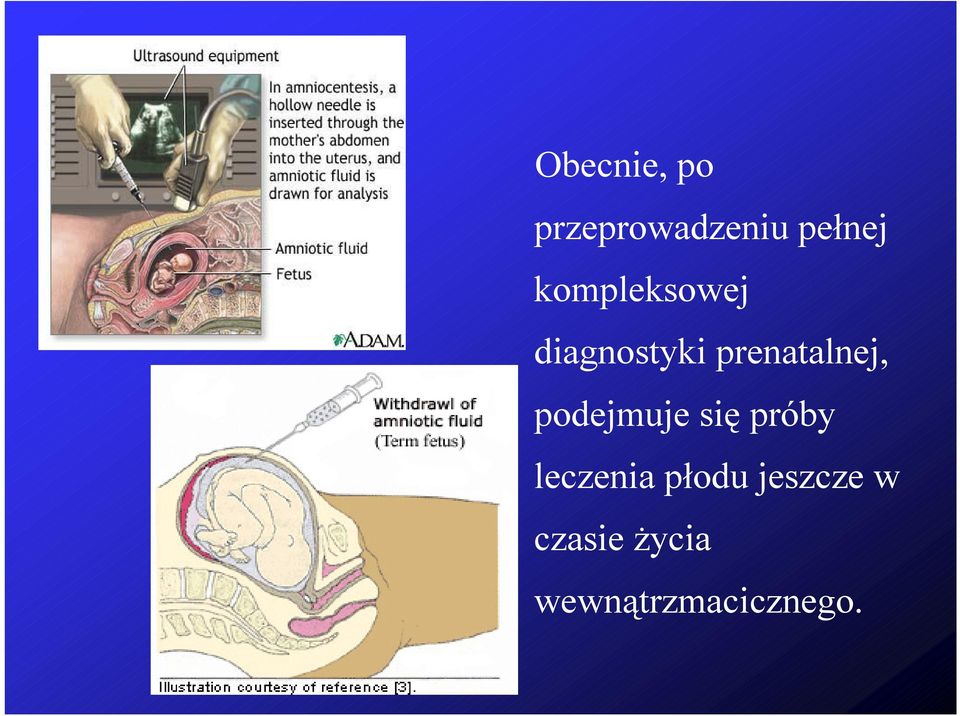 podejmuje się próby leczenia płodu