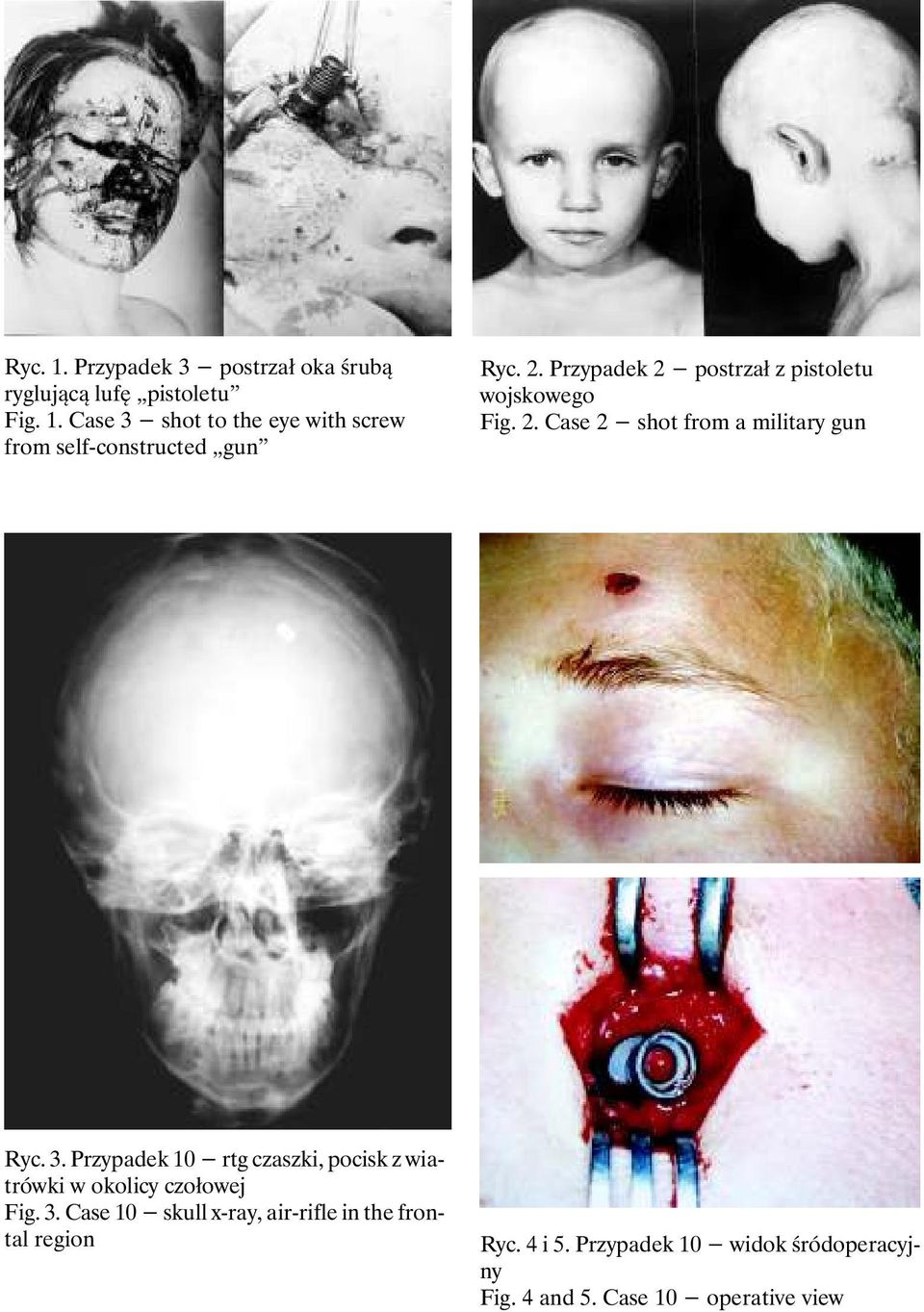 Przypadek 10 rtg czaszki, pocisk z w okolicy czołowej Fig. 3. Case 10 skull x-ray, air-rifle in the frontal region Ryc.