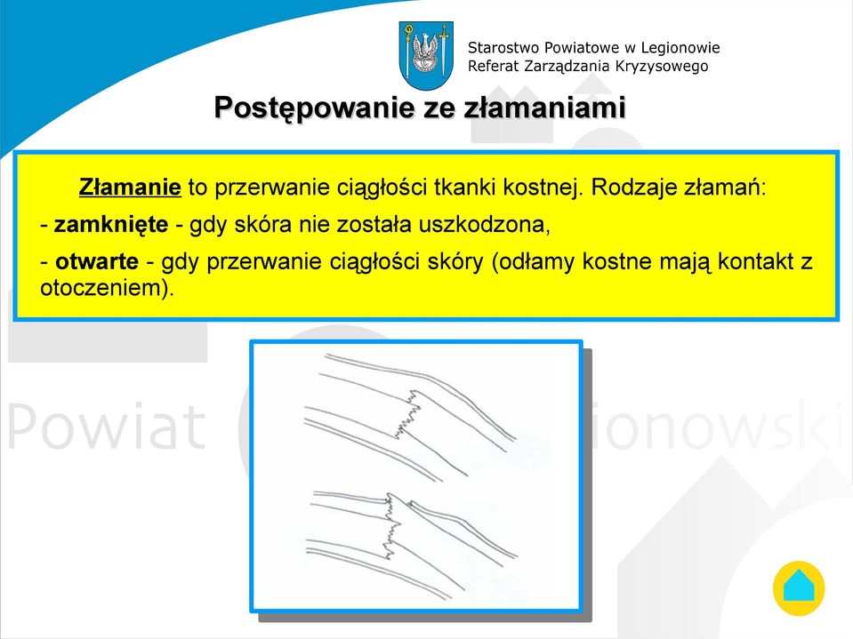 Rodzaje złamań: - zamknięte - gdy skóra nie została