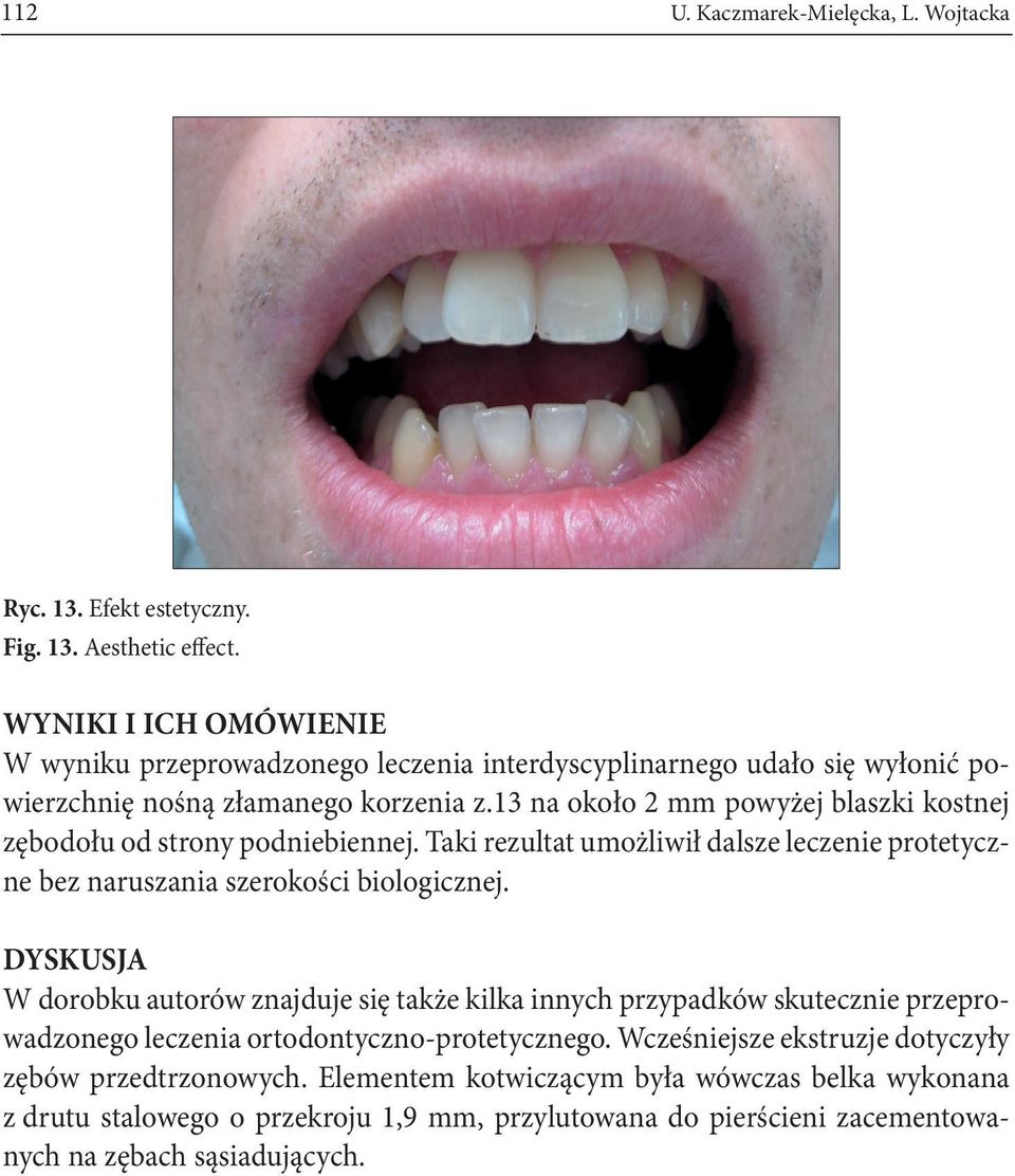 13 na około 2 mm powyżej blaszki kostnej zębodołu od strony podniebiennej. Taki rezultat umożliwił dalsze leczenie protetyczne bez naruszania szerokości biologicznej.