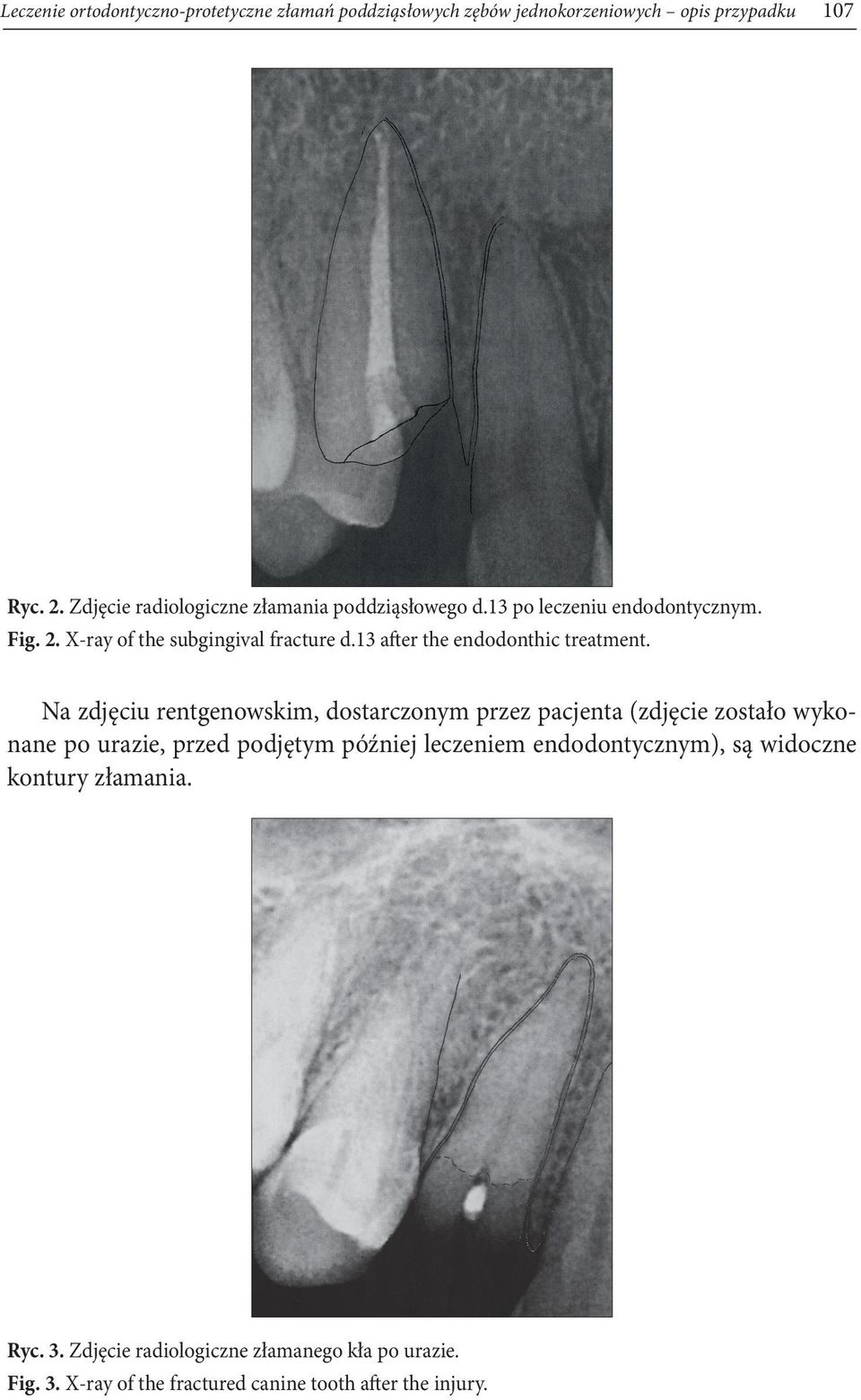 13 after the endodonthic treatment.