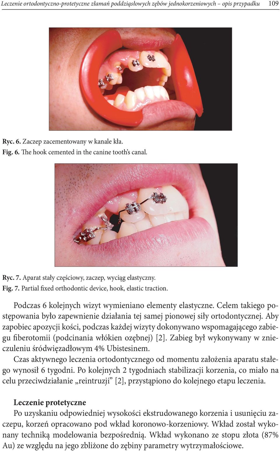 Celem takiego postępowania było zapewnienie działania tej samej pionowej siły ortodontycznej.