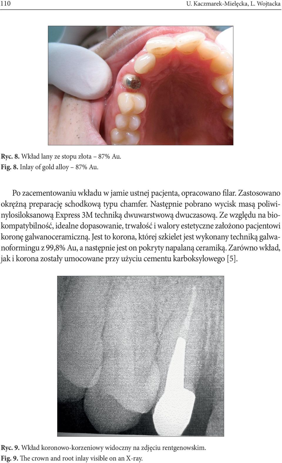 Ze względu na biokompatybilność, idealne dopasowanie, trwałość i walory estetyczne założono pacjentowi koronę galwanoceramiczną.