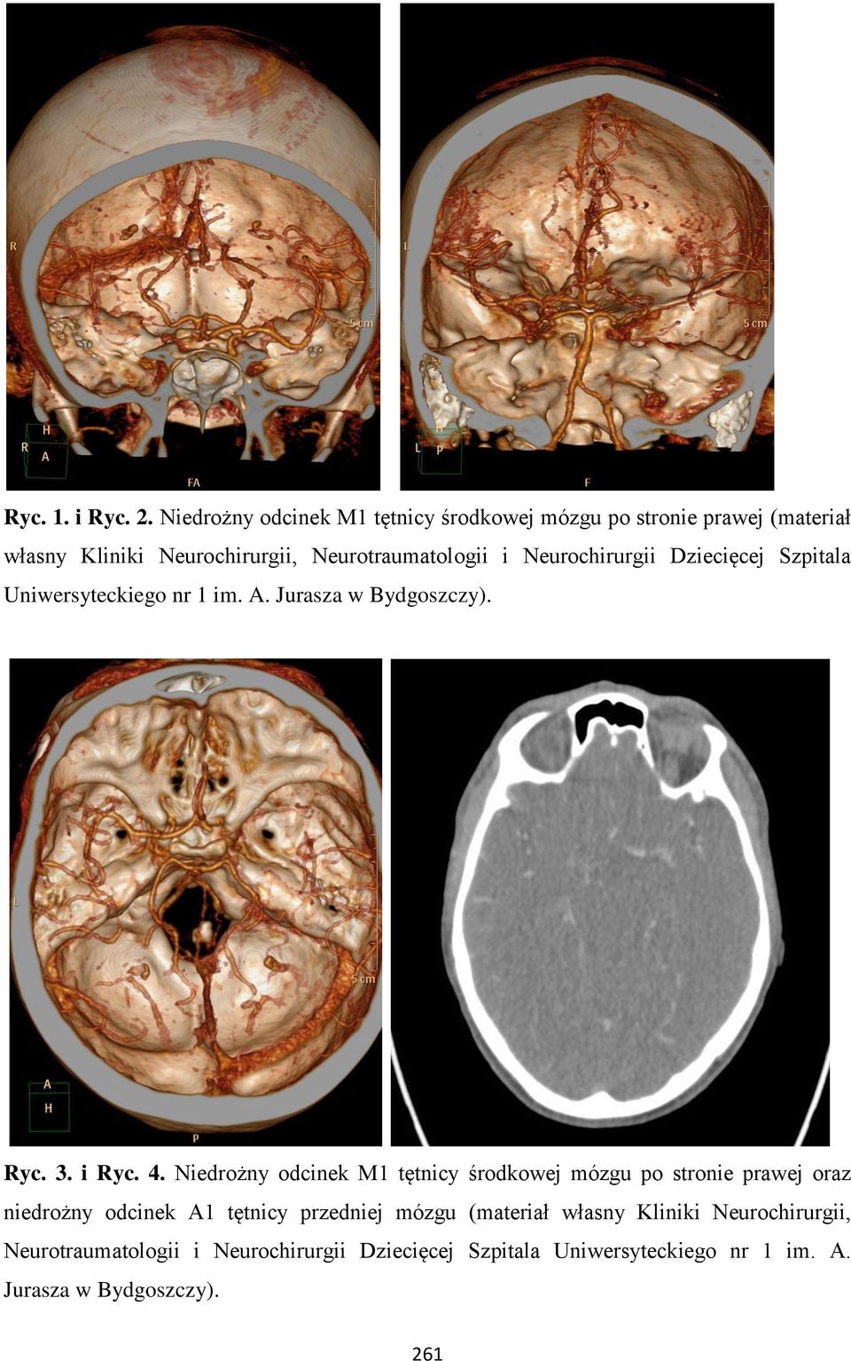 Neurochirurgii Dziecięcej Szpitala Uniwersyteckiego nr 1 im. A. Jurasza w Bydgoszczy). Ryc. 3. i Ryc. 4.