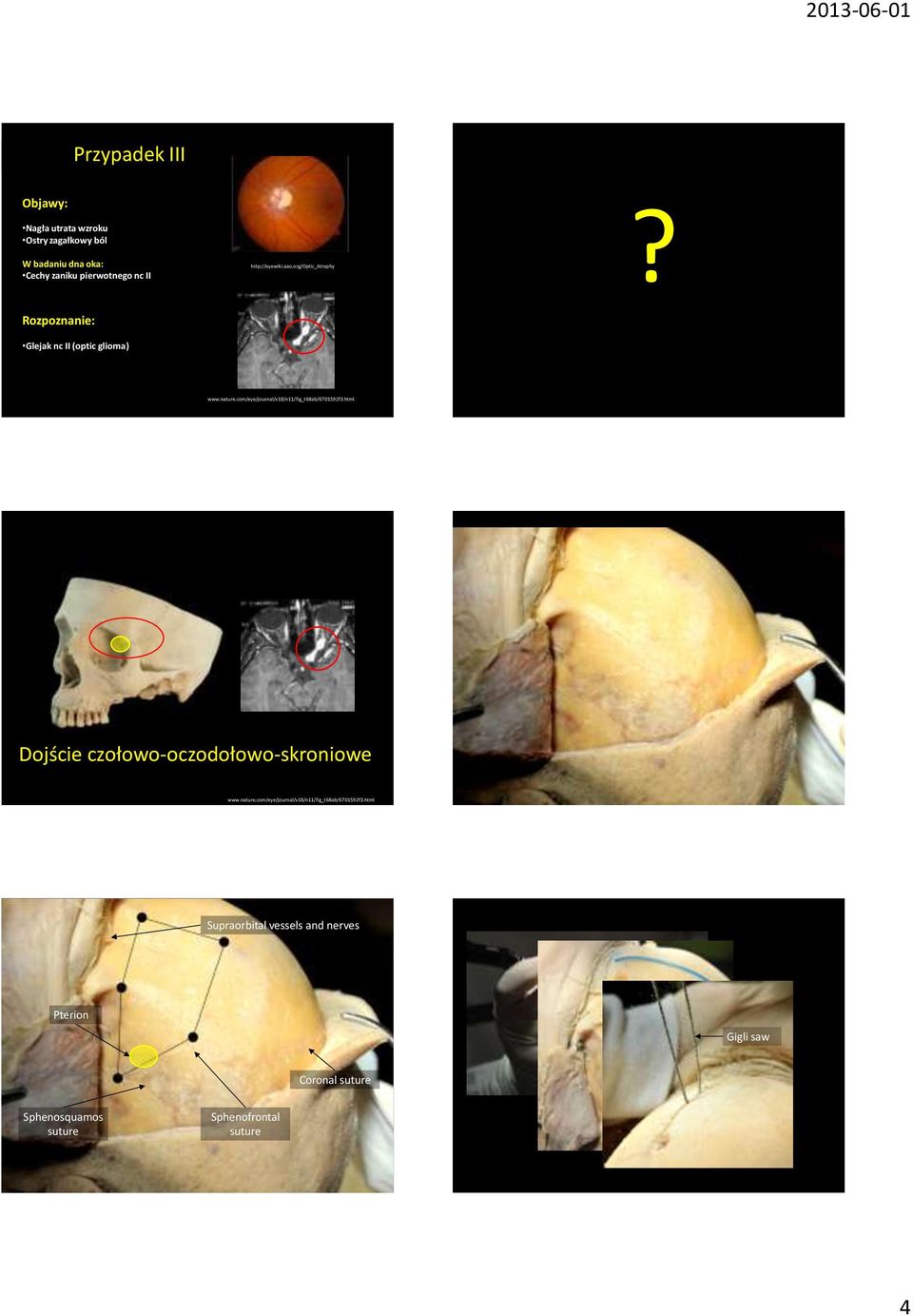 org/optic_atrophy Glejak nc II (optic glioma) Dojście czołowo-oczodołowo-skroniowe