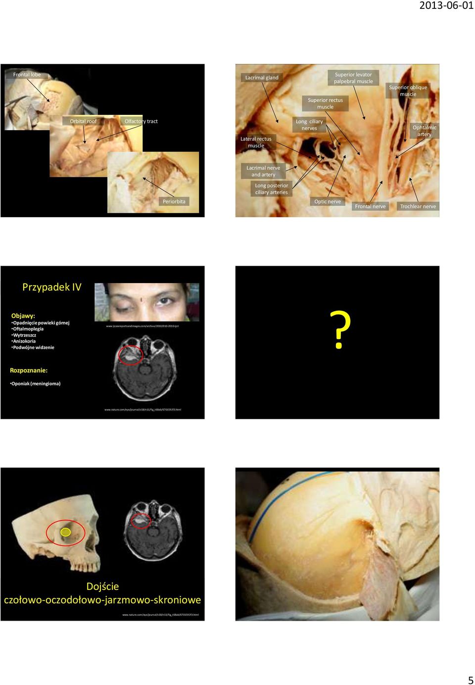 nerve Frontal nerve Trochlear nerve Przypadek IV Opadnięcie powieki górnej Oftalmoplegia Wytrzeszcz Anizokoria Podwójne