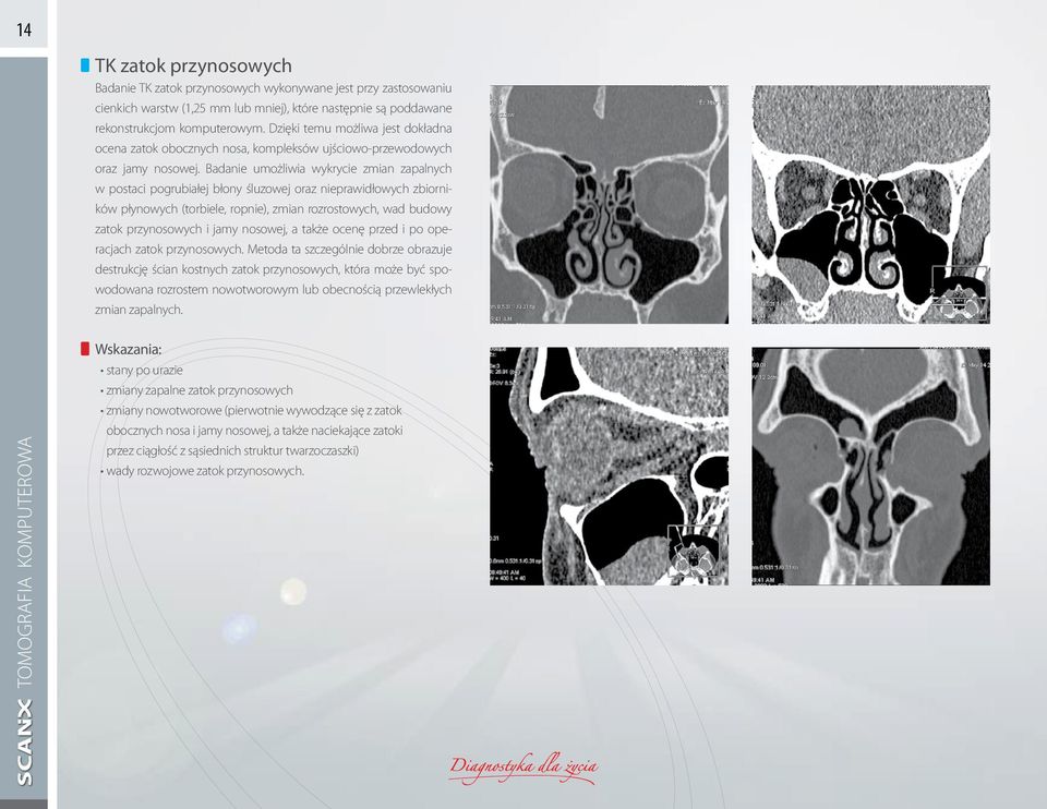 Badanie umożliwia wykrycie zmian zapalnych w postaci pogrubiałej błony śluzowej oraz nieprawidłowych zbiorników płynowych (torbiele, ropnie), zmian rozrostowych, wad budowy zatok przynosowych i jamy