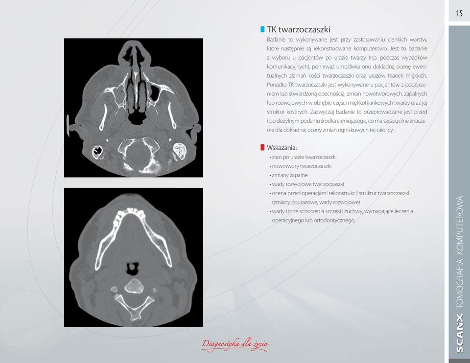 Ponadto TK twarzoczaszki jest wykonywane u pacjentów z podejrzeniem lub stwierdzoną obecnością zmian nowotworowych, zapalnych lub rozwojowych w obrębie części miękkotkankowych twarzy oraz jej