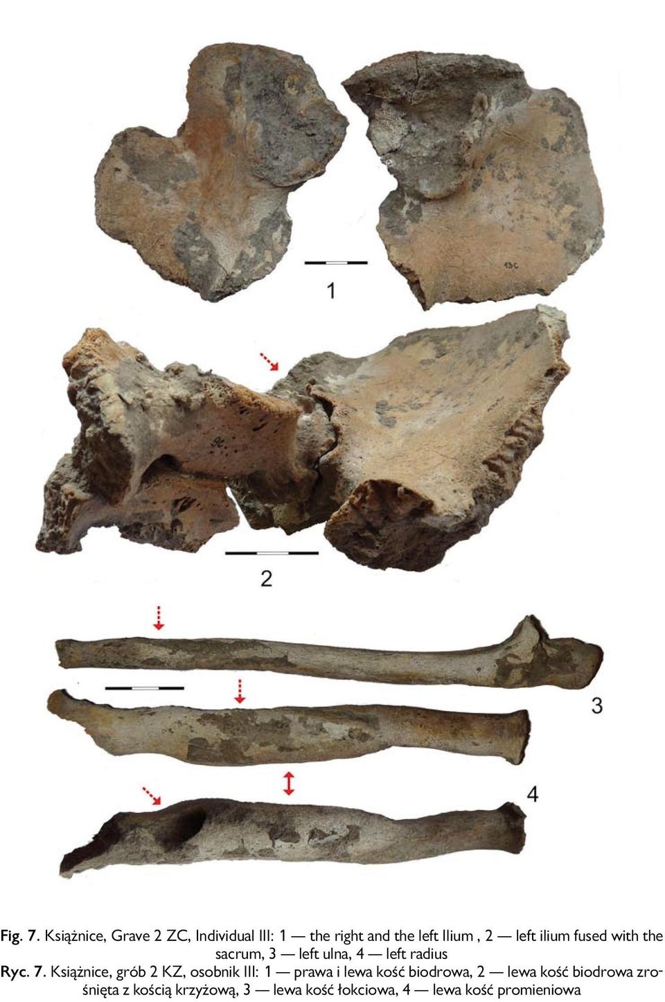 ilium fused with the sacrum, 3 left ulna, 4 left radius Ryc. 7.