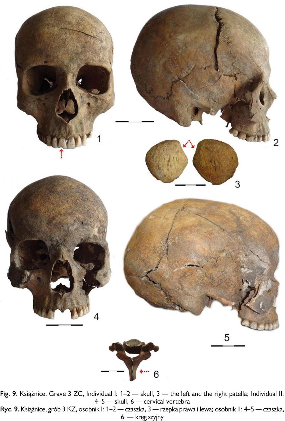 the right patella; Individual II: 4 5 skull, 6 cervical