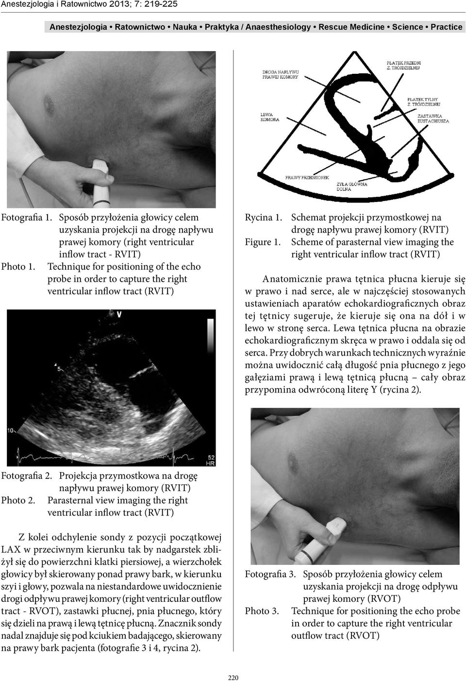 Scheme of parasternal view imaging the right ventricular inflow tract (RVIT) Anatomicznie prawa tętnica płucna kieruje się w prawo i nad serce, ale w najczęściej stosowanych ustawieniach aparatów