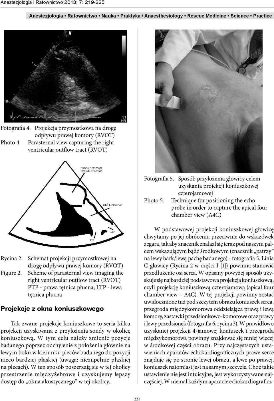 Schemat projekcji przymostkowej na drogę odpływu prawej komory (RVOT) Figure 2.