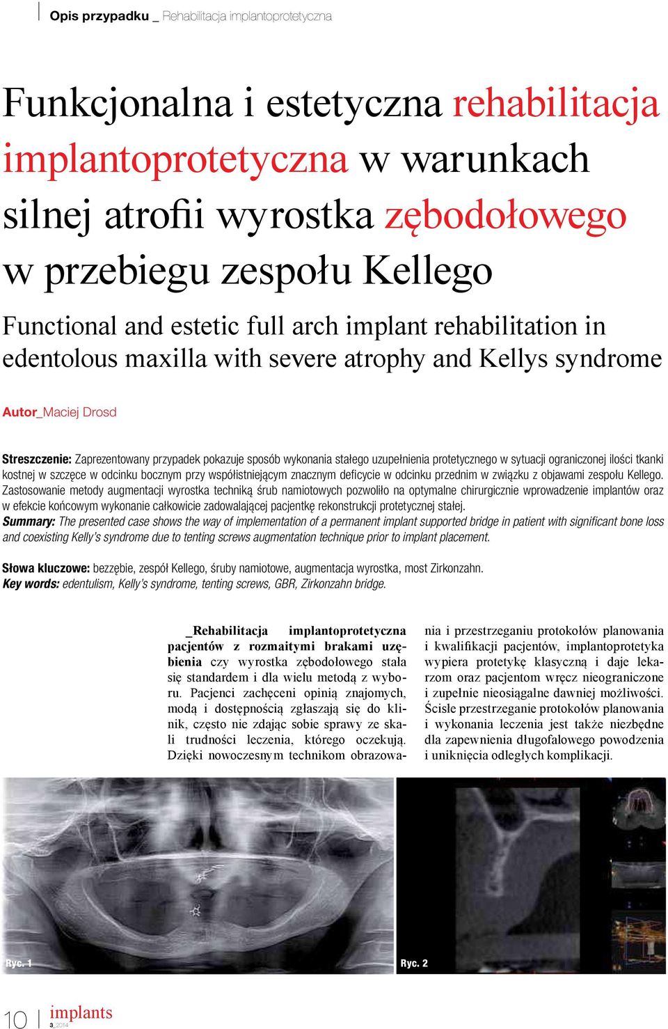 ograniczonej ilości tkanki kostnej w szczęce w odcinku bocznym przy współistniejącym znacznym deicycie w odcinku przednim w związku z objawami zespołu Kellego.