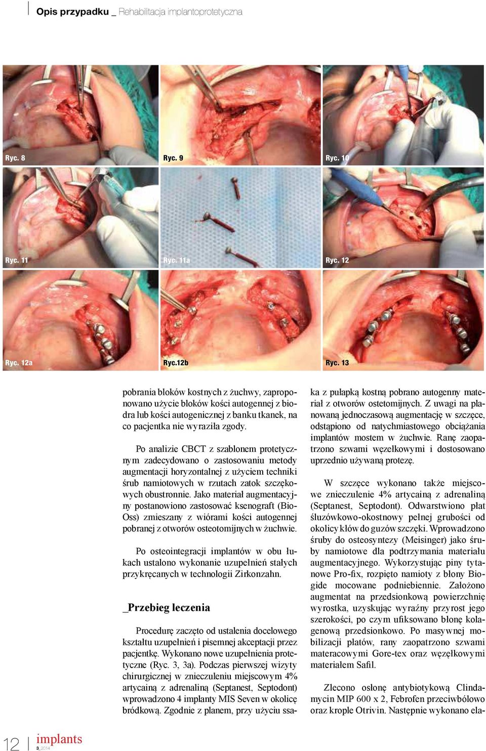 Po analizie CBCT z szablonem protetycznym zadecydowano o zastosowaniu metody augmentacji horyzontalnej z użyciem techniki śrub namiotowych w rzutach zatok szczękowych obustronnie.