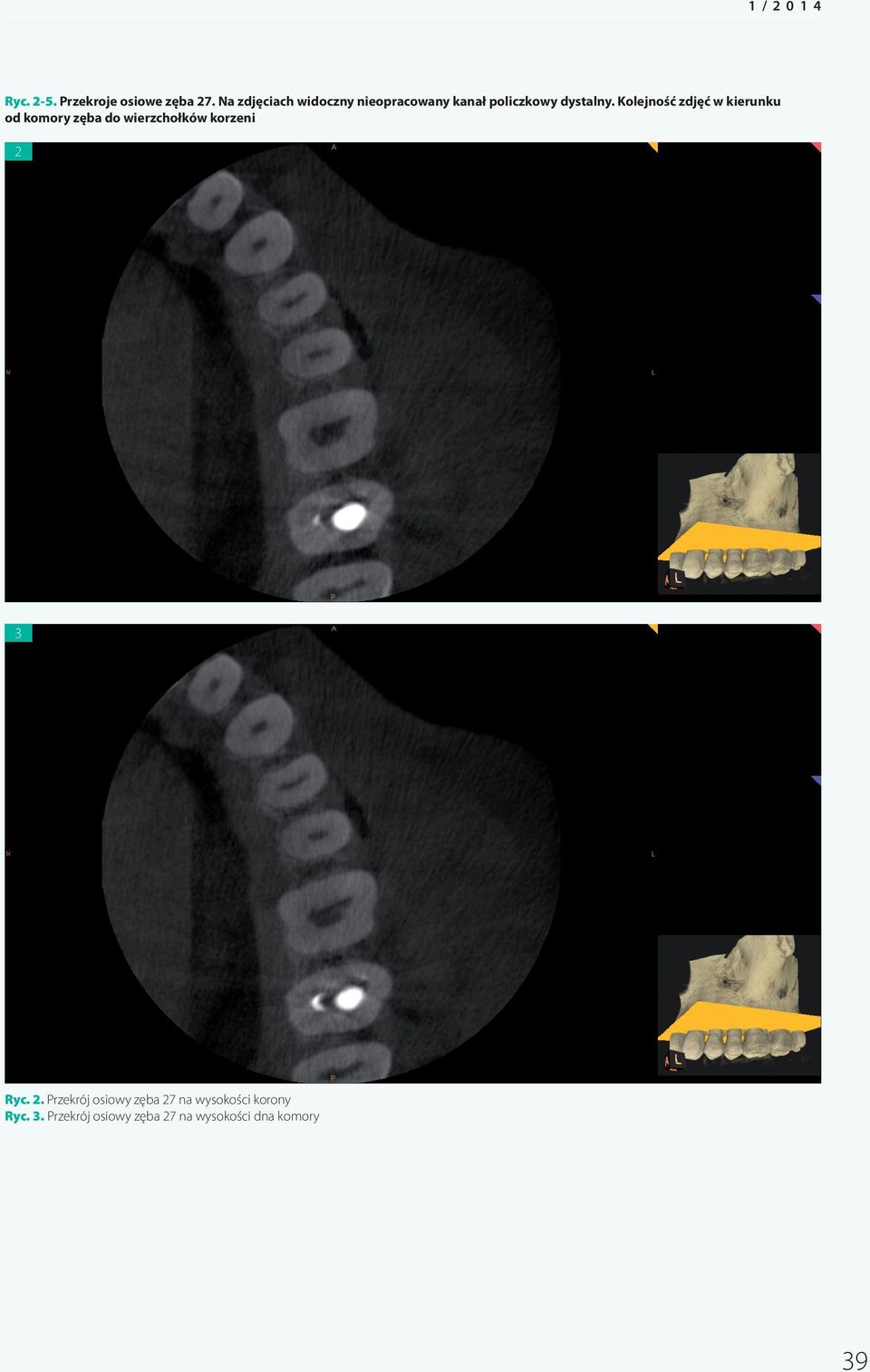 Kolejność zdjęć w kierunku od komory zęba do wierzchołków korzeni 2 3