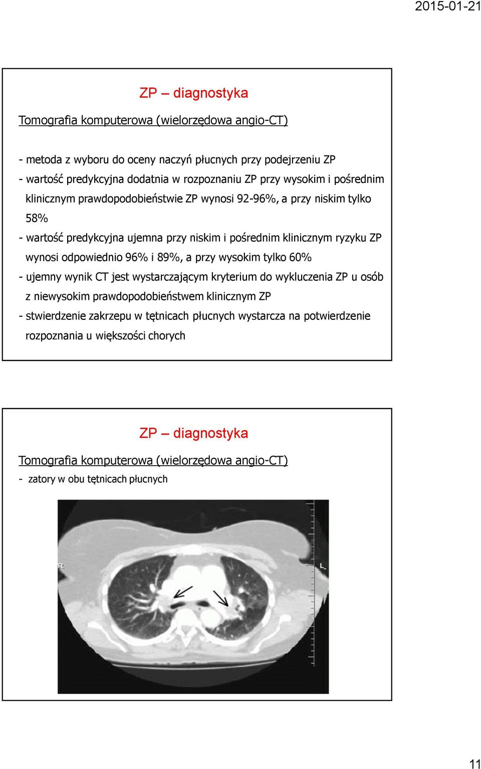 odpowiednio 96% i 89%, a przy wysokim tylko 60% - ujemny wynik CT jest wystarczającym kryterium do wykluczenia ZP u osób z niewysokim prawdopodobieństwem klinicznym ZP -