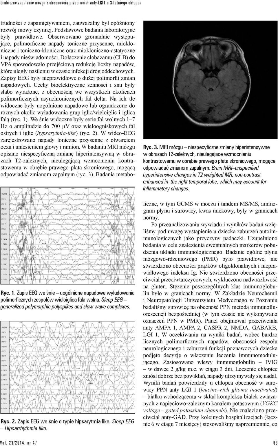 MRI mózgu niespecyficzne zmiany hiperintensywne w obrazach T2-zależnych, nieulegające wzmocnieniu kontrastowemu w obrębie prawego płata skroniowego, mogące odpowiadać zmianom zapalnym.