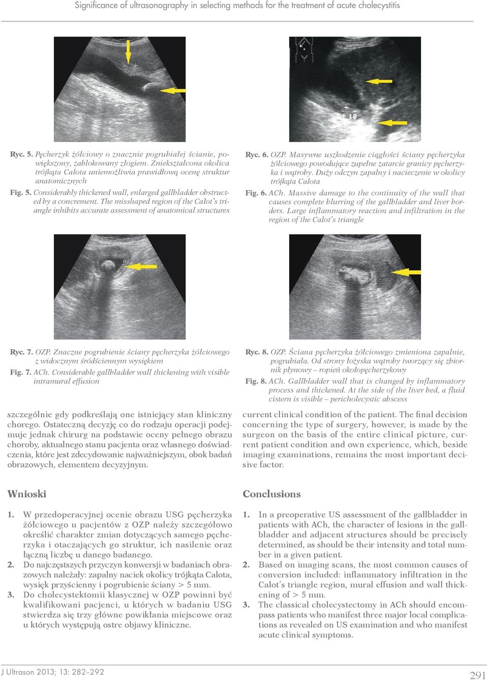 The misshaped region of the Calot s triangle inhibits accurate assessment of anatomical structures Ryc. 6. OZP.