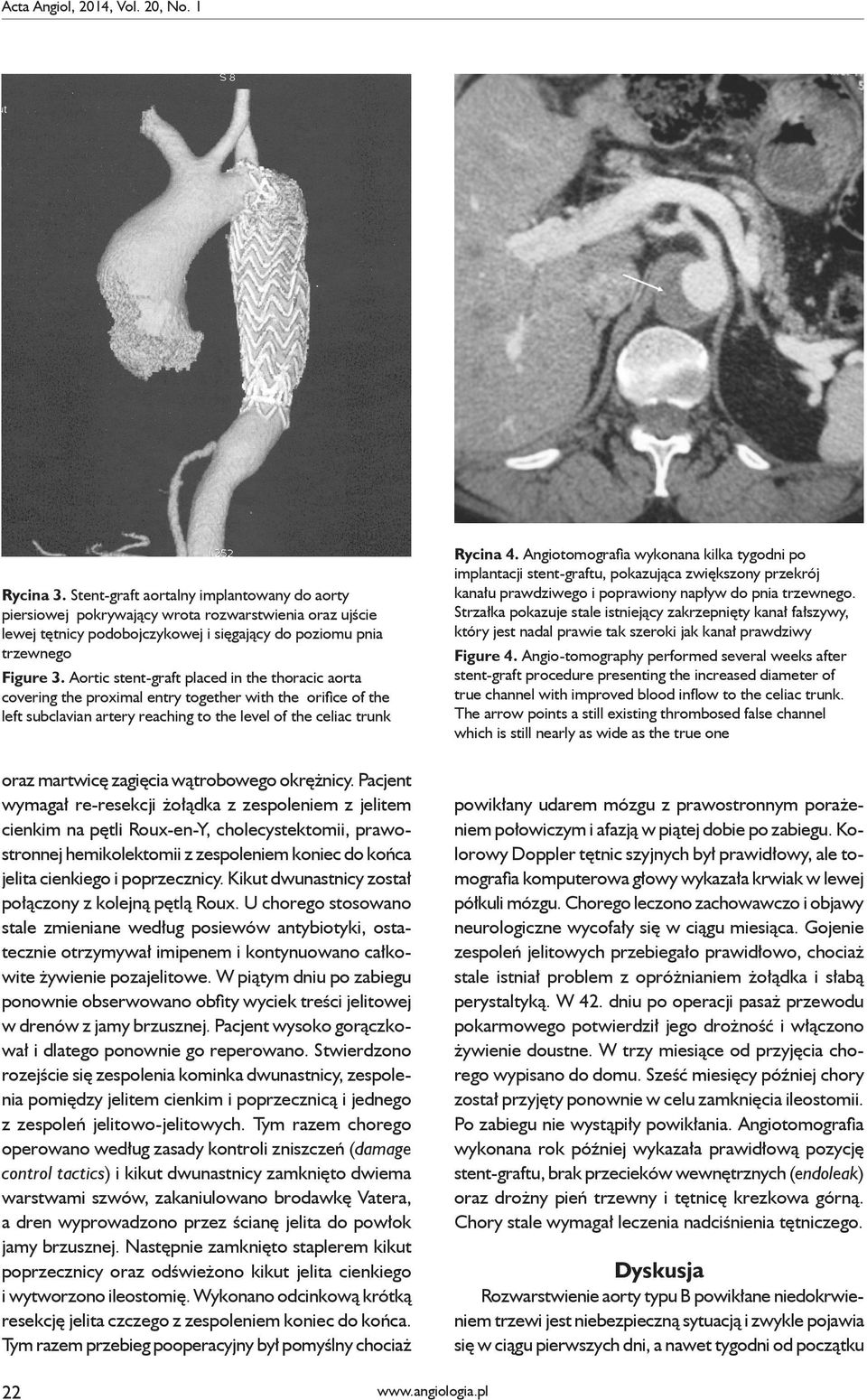 Aortic stent-graft placed in the thoracic aorta covering the proximal entry together with the orifice of the left subclavian artery reaching to the level of the celiac trunk Rycina 4.