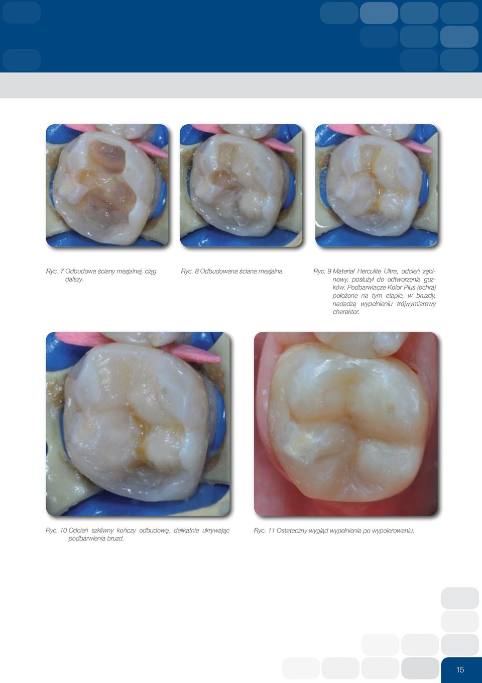 9 Materiał Herculite Ultra, odcień zębinowy, posłużył do odtworzenia guzków.