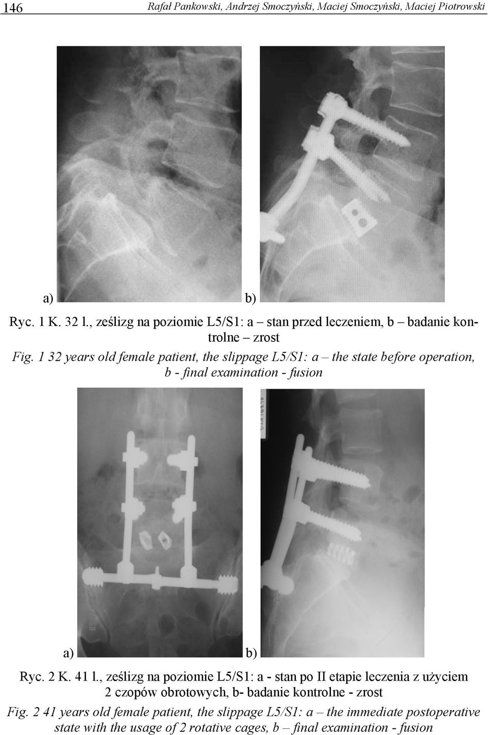 1 32 years old female patient, the slippage L5/S1: a the state before operation, b - final examination - fusion a) b) Ryc. 2 K. 41 l.