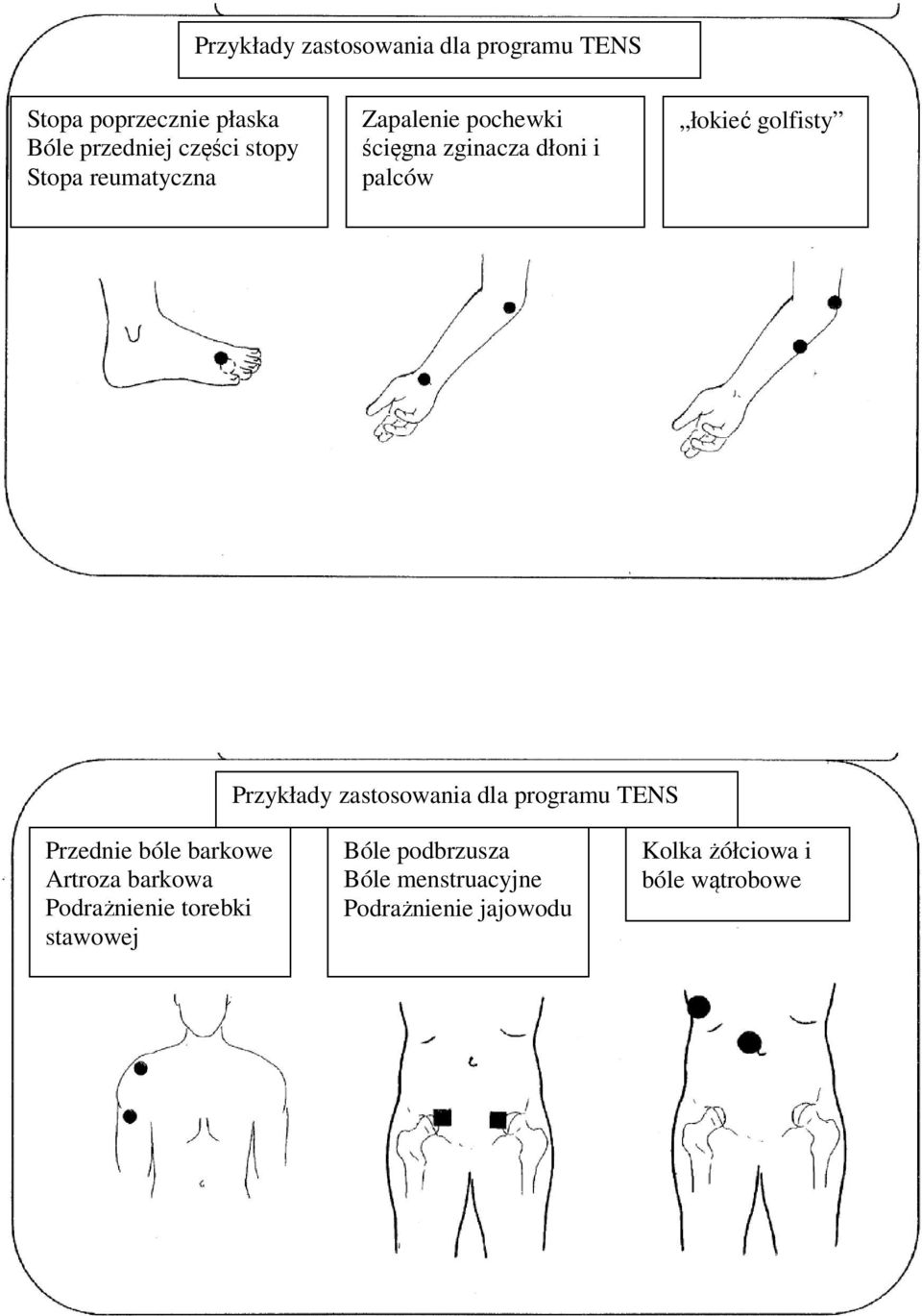 Przykłady zastosowania dla programu TENS Przednie bóle barkowe Artroza barkowa Podrażnienie