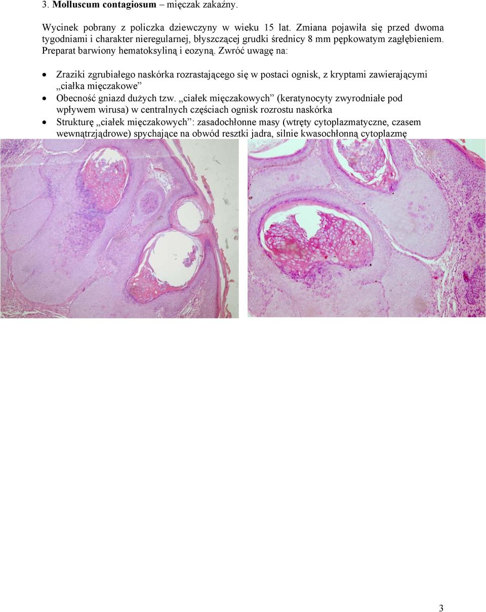 Zwróć uwagę na: Zraziki zgrubiałego naskórka rozrastającego się w postaci ognisk, z kryptami zawierającymi ciałka mięczakowe Obecność gniazd dużych tzw.