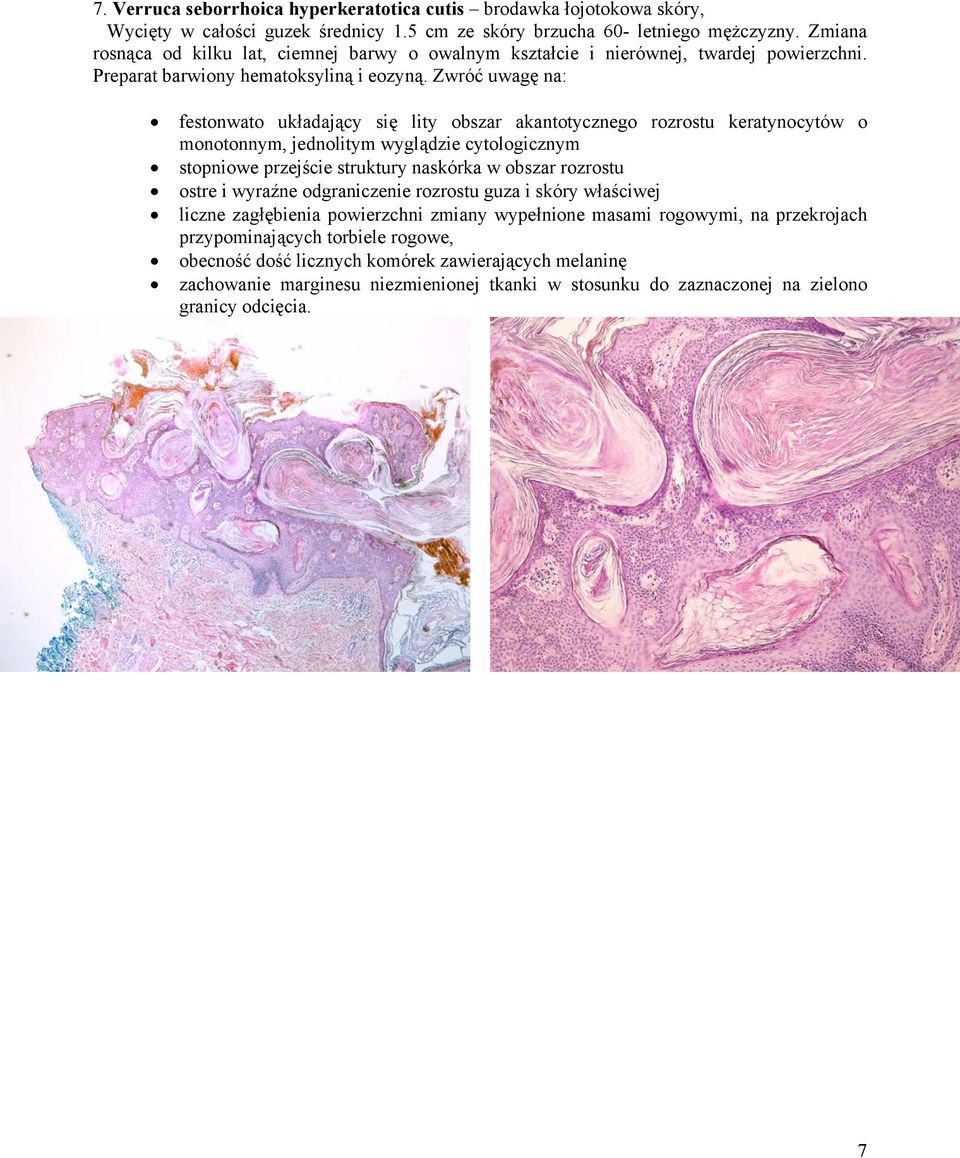 Zwróć uwagę na: festonwato układający się lity obszar akantotycznego rozrostu keratynocytów o monotonnym, jednolitym wyglądzie cytologicznym stopniowe przejście struktury naskórka w obszar rozrostu