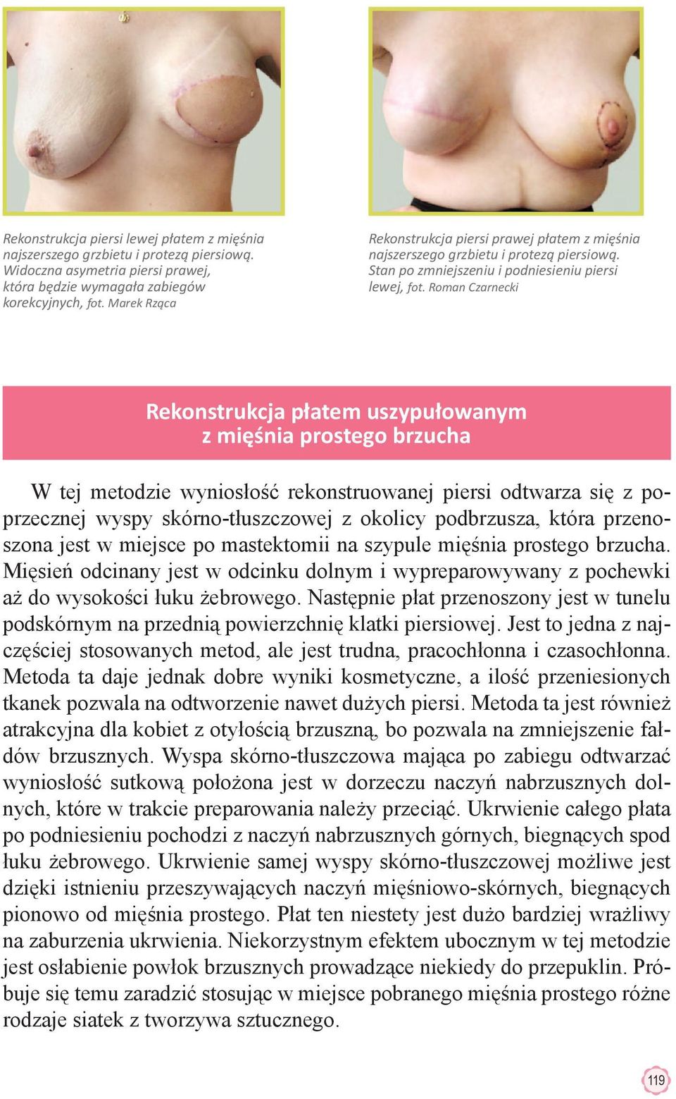 Roman Czarnecki Rekonstrukcja płatem uszypułowanym z mięśnia prostego brzucha W tej metodzie wyniosłość rekonstruowanej piersi odtwarza się z poprzecznej wyspy skórno-tłuszczowej z okolicy