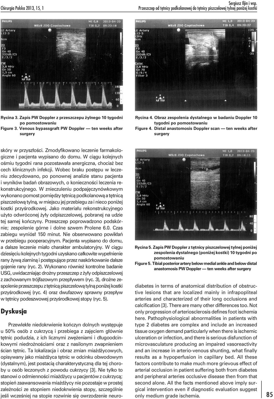 Obraz zespolenia dystalnego w badaniu Doppler 10 tygodni po pomostowaniu Figure 4. Distal anastomosis Doppler scan ten weeks after surgery skóry w przyszłości.