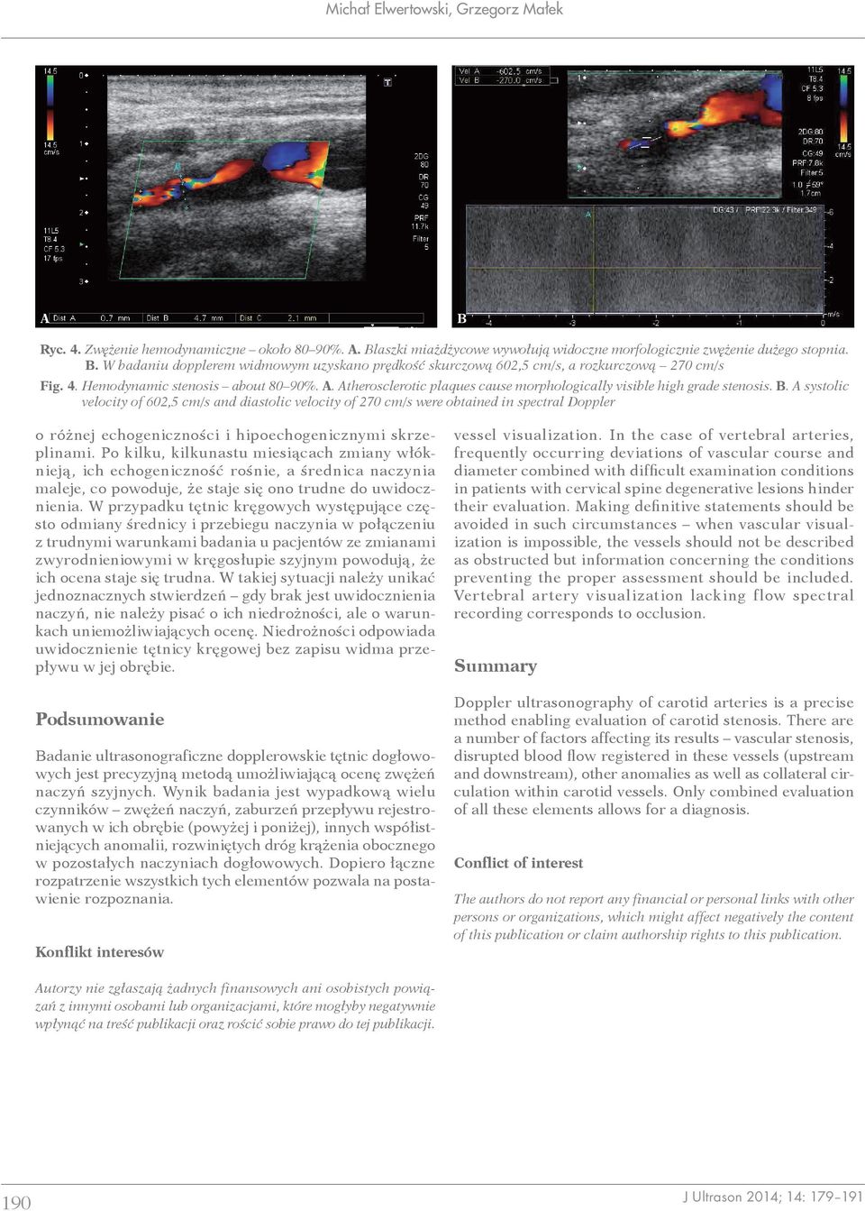 A systolic velocity of 602,5 cm/s and diastolic velocity of 270 cm/s were obtained in spectral Doppler o różnej echogeniczności i hipoechogenicznymi skrzeplinami.