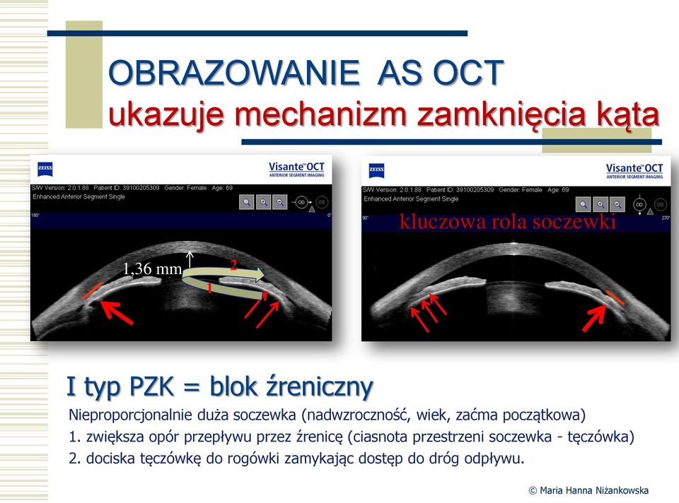 (nadwzroczność, wiek, zaćma początkowa) 1.